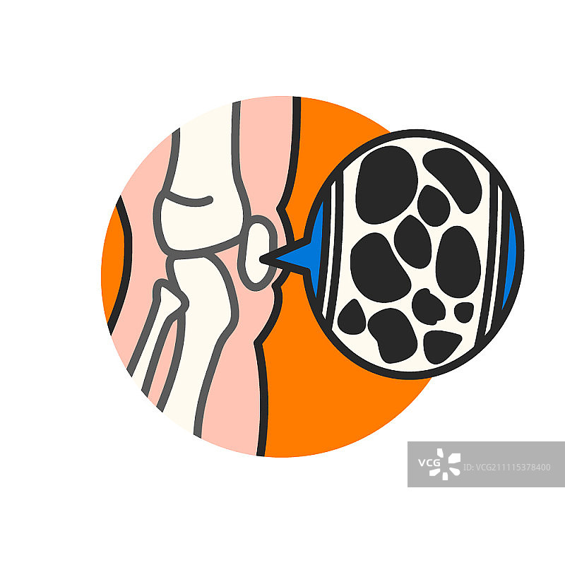 骨质疏松症图片素材
