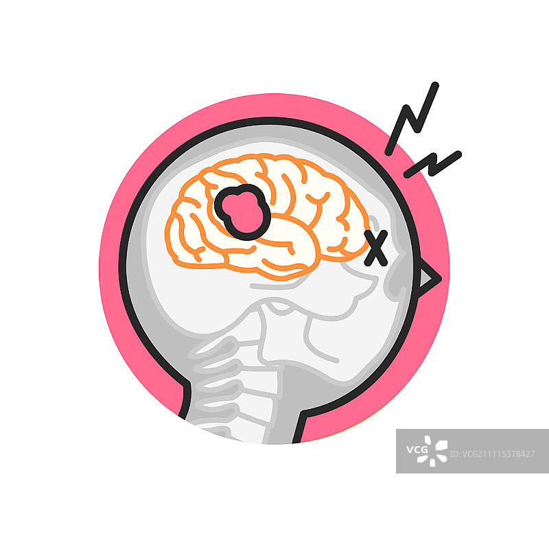 脑肿瘤图片素材