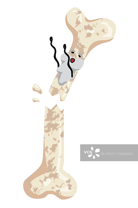 骨折 骨质疏松图片素材