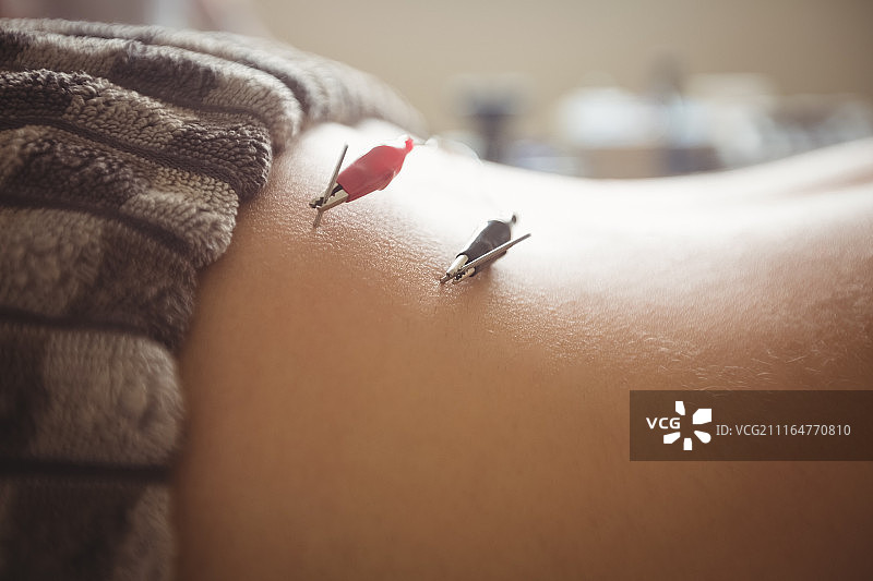 患者接受电针治疗特写图片素材