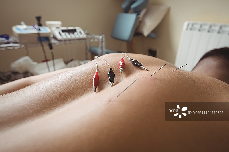 病人背部接受电干针治疗的中段图片素材