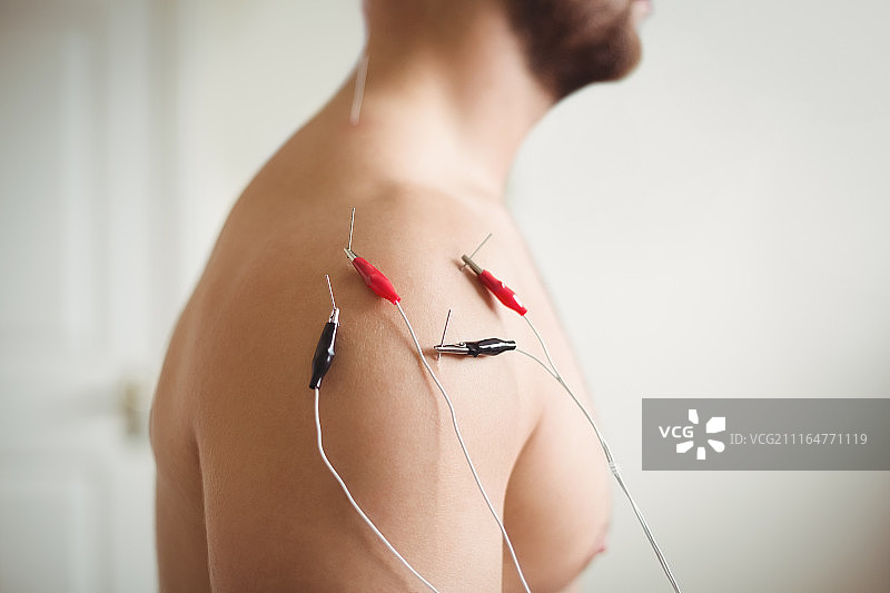 患者接受电针治疗特写图片素材