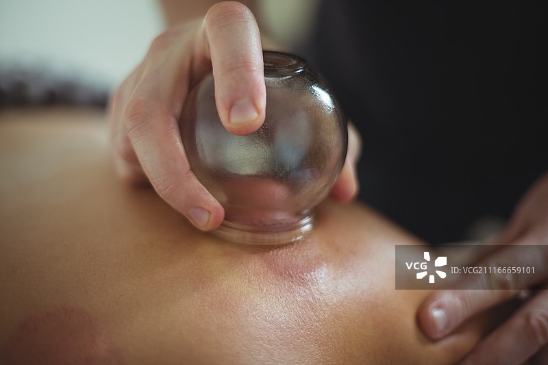 理疗师为男人拔罐疗法的特写图片素材