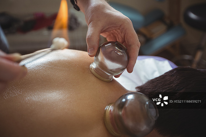 理疗师为男士进行火罐疗法图片素材