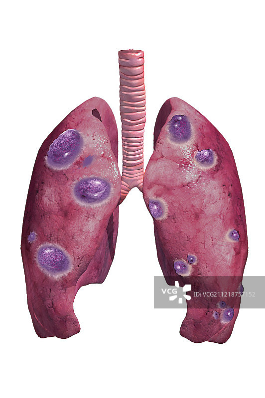 不健康的肺图片素材