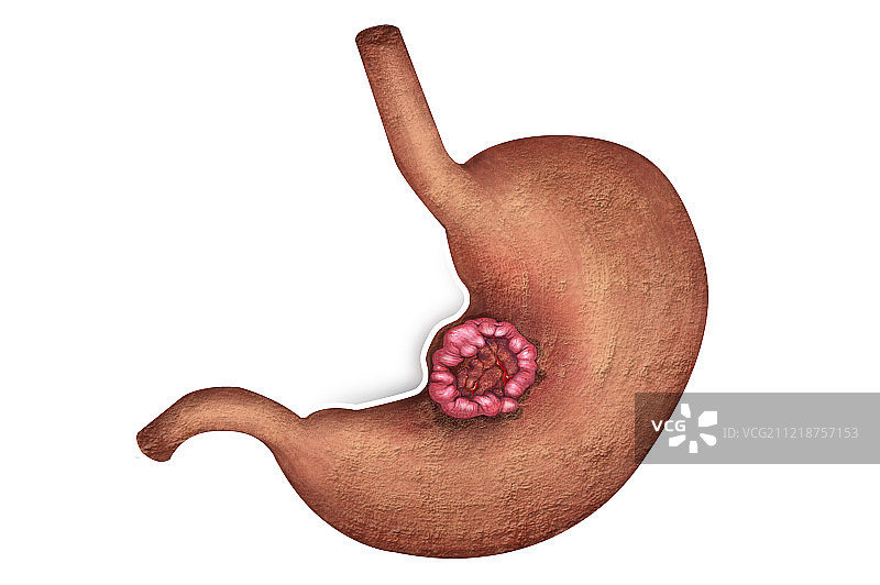 不健康的胃图片素材