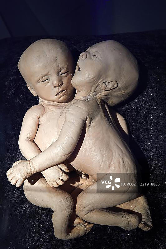 人体塑化标本连体双胞胎，人体世界展览，人类博物馆，德国柏林图片素材