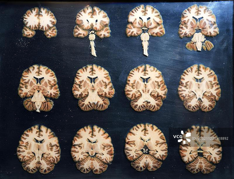 人体塑化标本，人脑横截面，人体世界展览，人类博物馆，德国柏林图片素材
