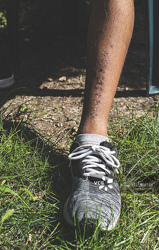 腿部缝合伤口图片素材