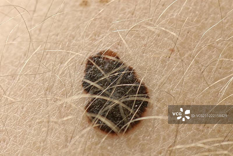 恶性黑色素瘤，黑色皮肤癌，细节，德国，欧洲图片素材