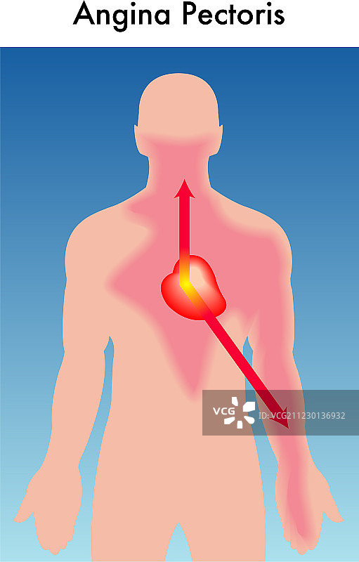 心绞痛图片素材