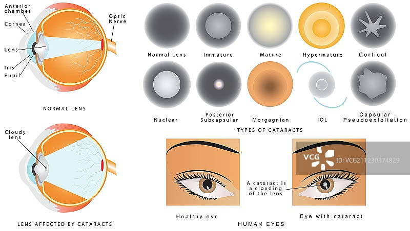 白内障图片素材