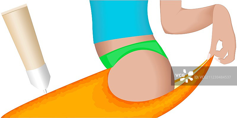 橘皮效应的脂肪团图片素材