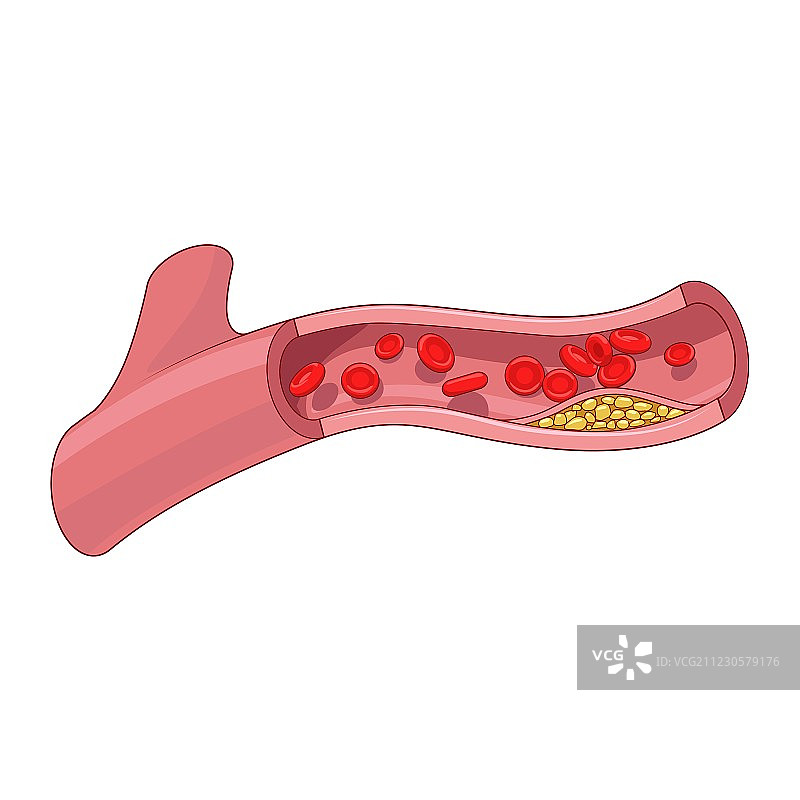 血管和胆固醇斑块图片素材