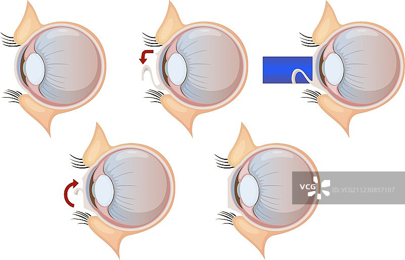 激光视力矫正图片素材