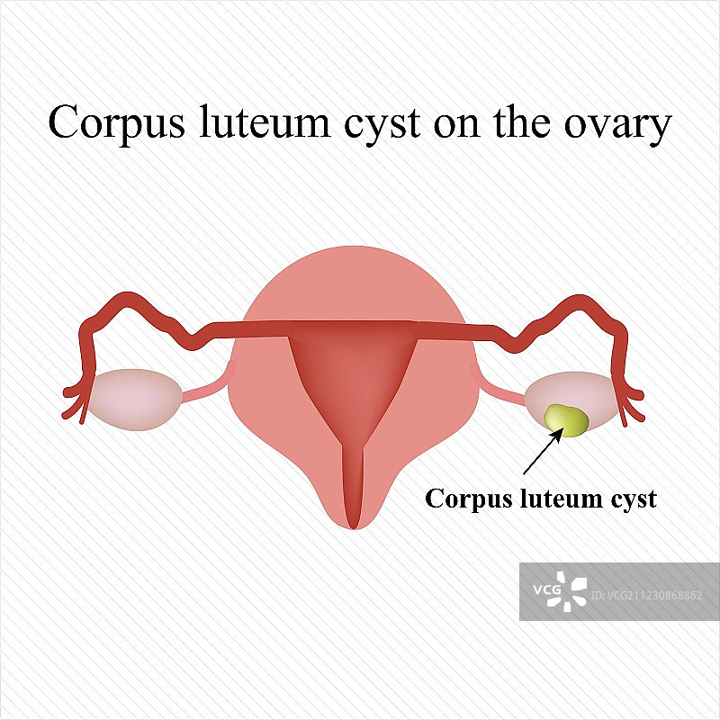 卵巢黄体囊肿功能性囊肿图片素材