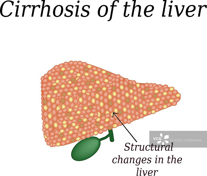 肝硬化图片素材