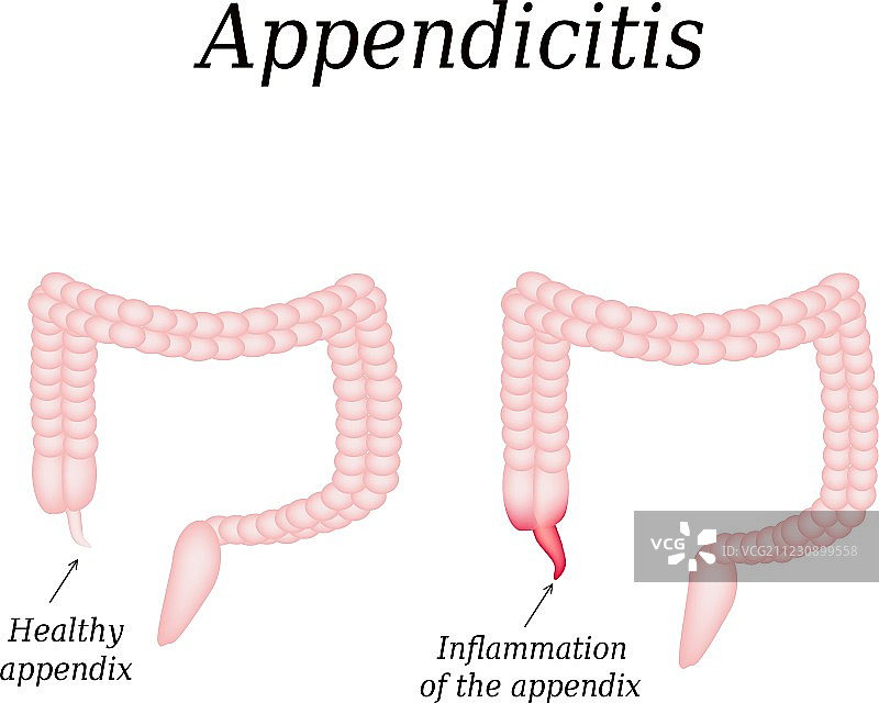 阑尾炎：阑尾结肠炎症图片素材