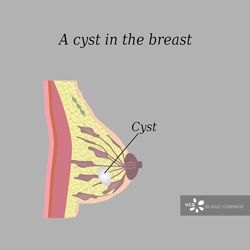 乳房囊肿灰色背景图片素材