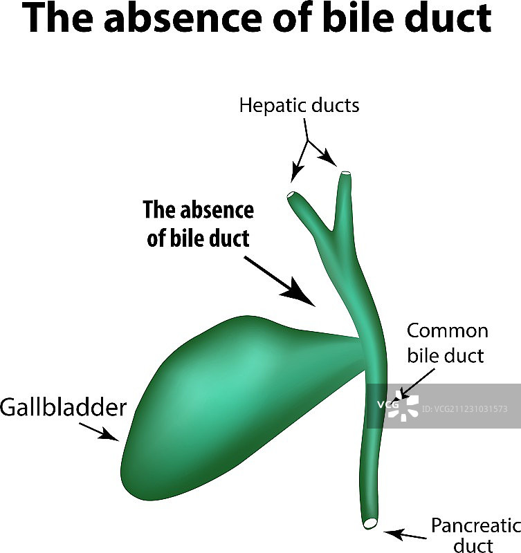 胆管病理学缺失图片素材