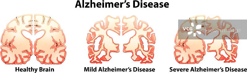 阿尔茨海默病图片素材