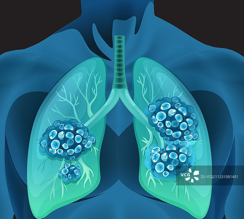 人体中的肺癌图片素材