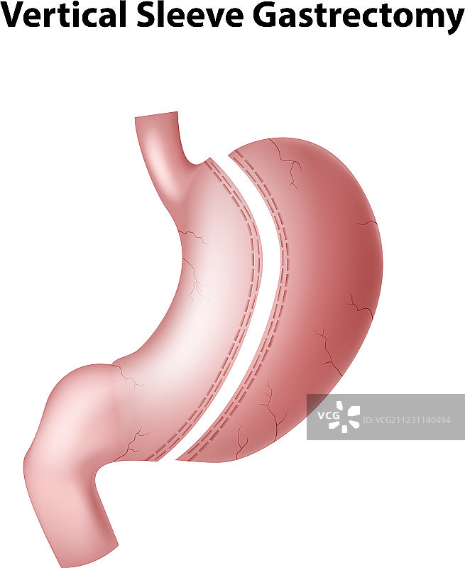 袖状胃切除术的卡通图片素材