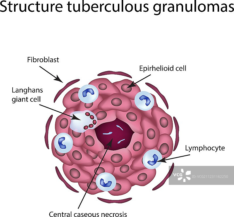 结核性肉芽肿的结构图片素材