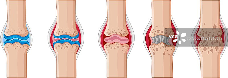 人类关节中的类风湿性关节炎图片素材