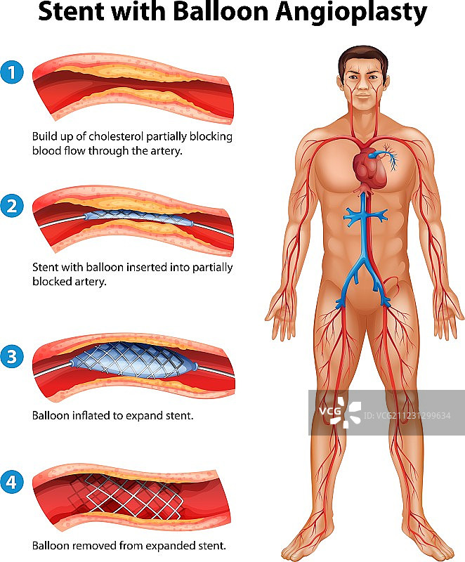 支架血管成形术图片素材