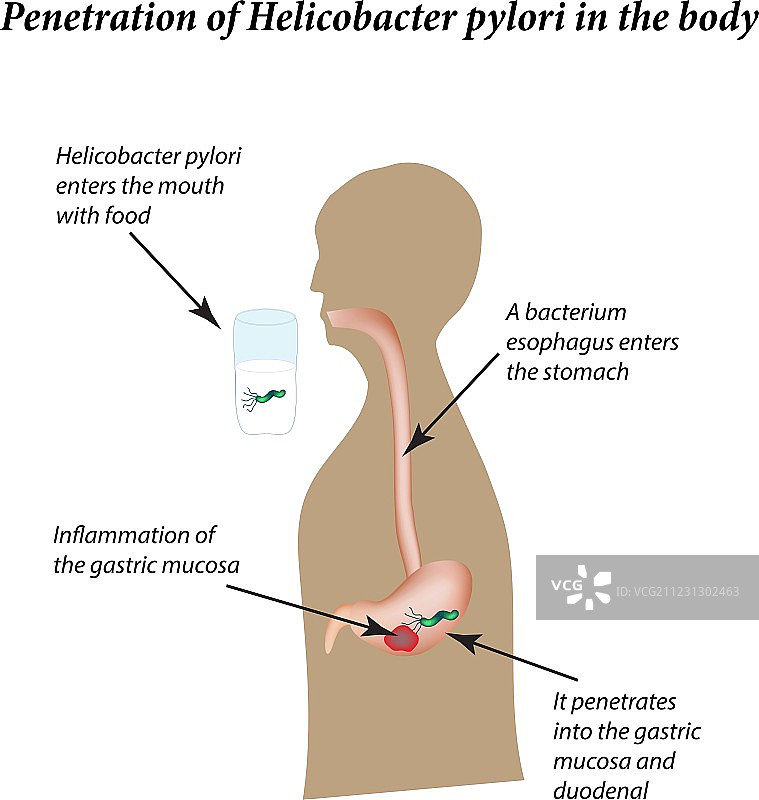 幽门螺杆菌感染信息图图片素材