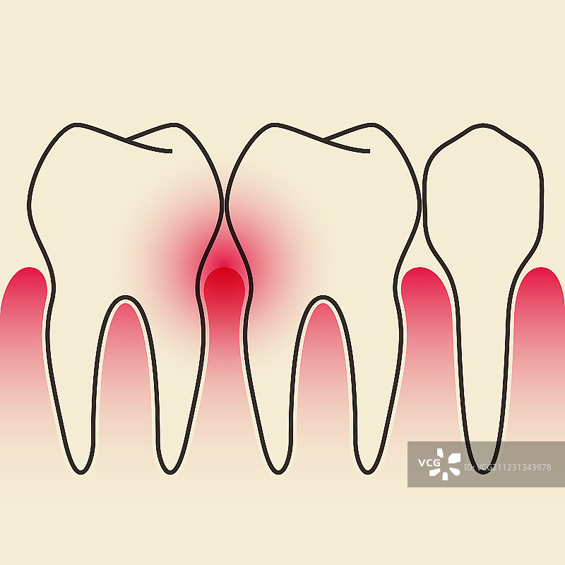 牙周病图片素材
