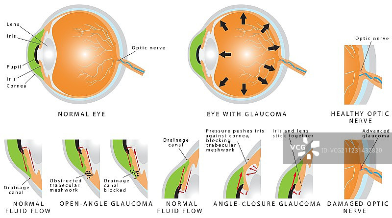 青光眼图片素材