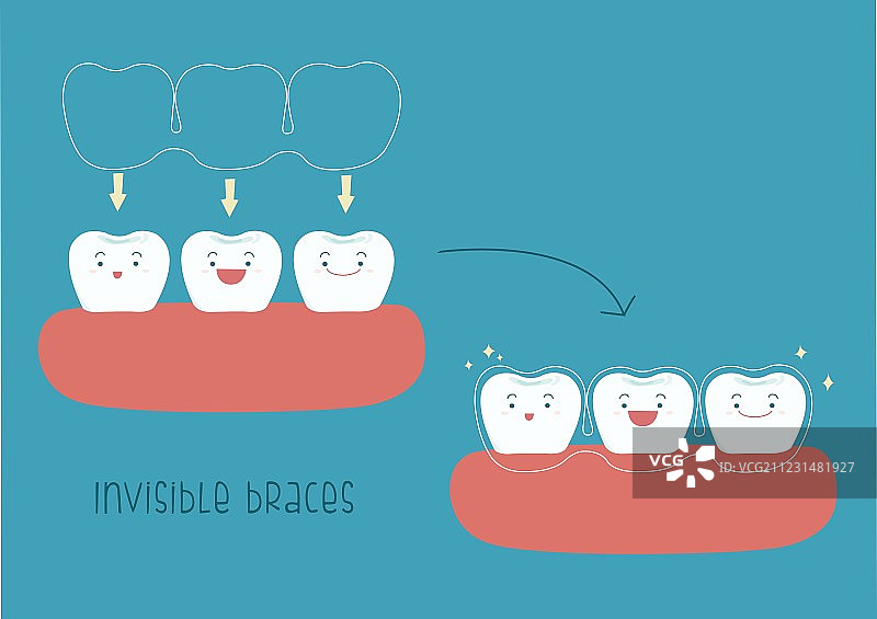 牙齿概念隐形牙套制作方法图片素材