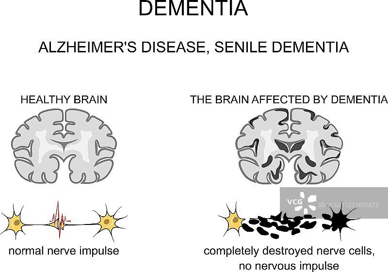 阿尔茨海默病发病机制图片素材