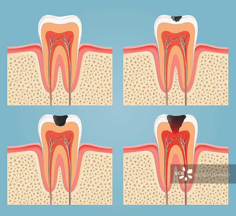 牙齿腐烂的阶段图片素材