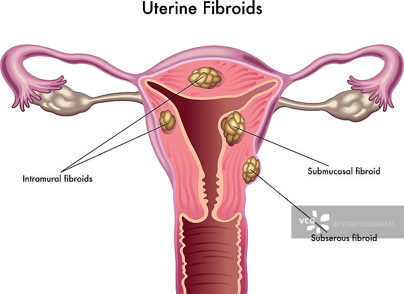 子宫肌瘤图片素材