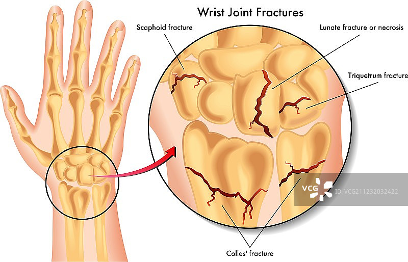 腕关节骨折图片素材