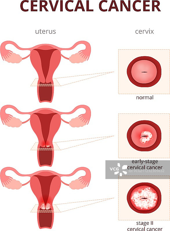 宫颈癌示意图图片素材