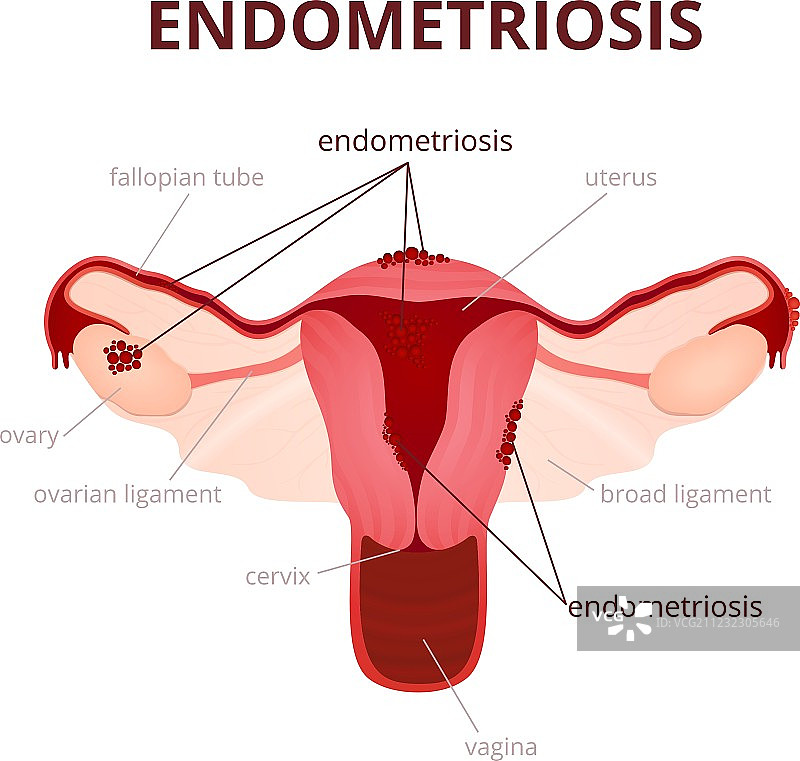 子宫内膜异位症图片素材