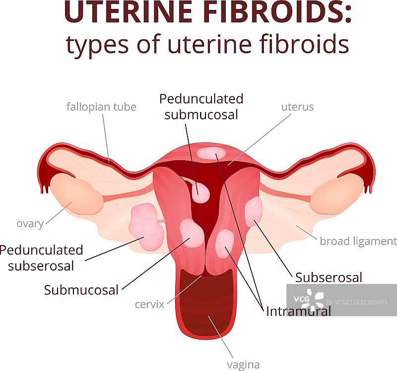子宫肌瘤示意图图片素材