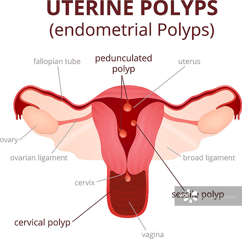 子宫息肉分类图片素材