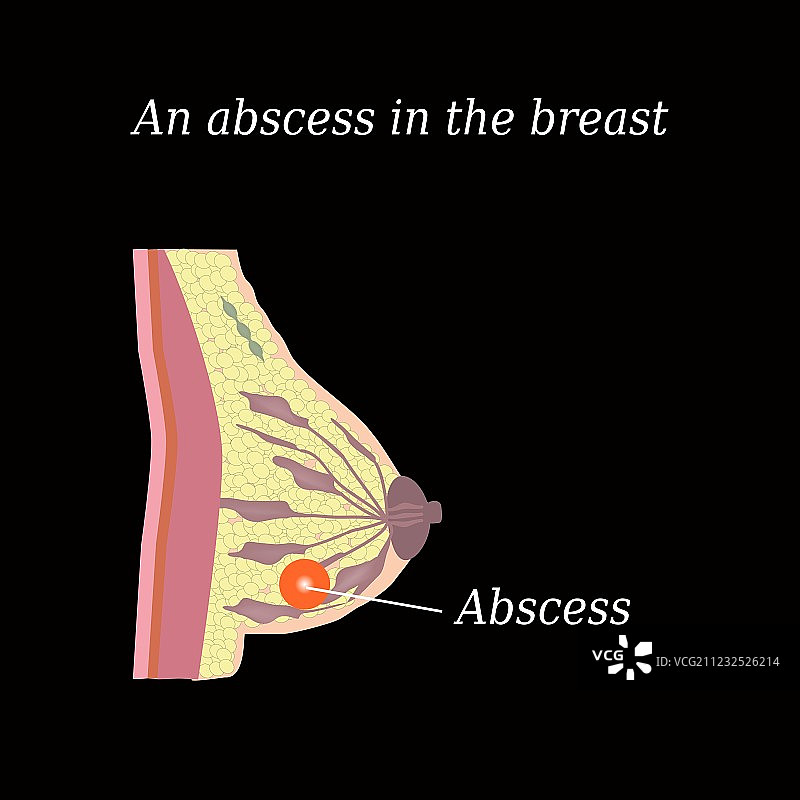 胸部脓肿结构图片素材