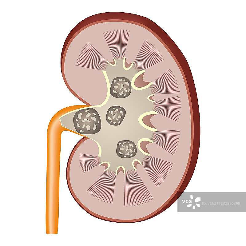 肾结石图片素材