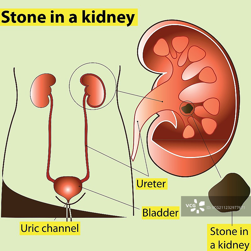 肾结石图片素材