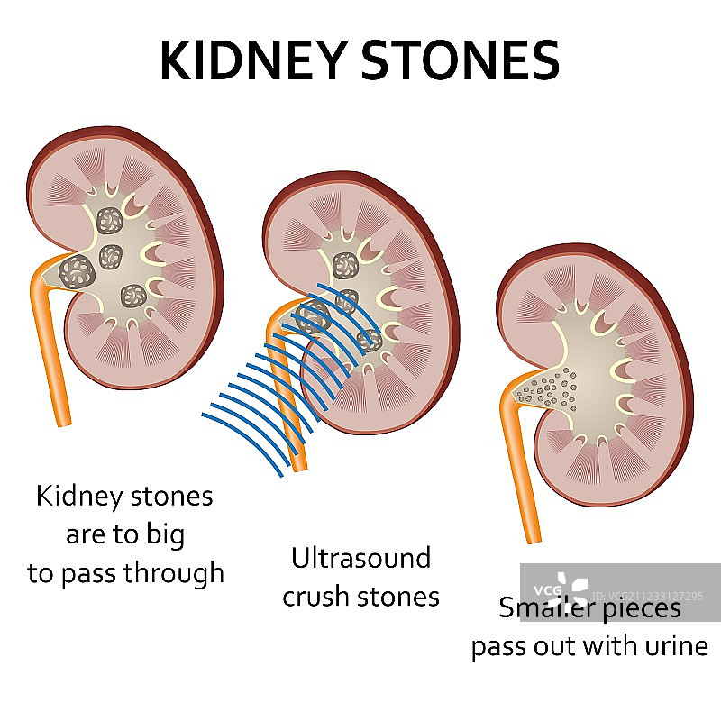 用冲击波击碎肾结石图片素材