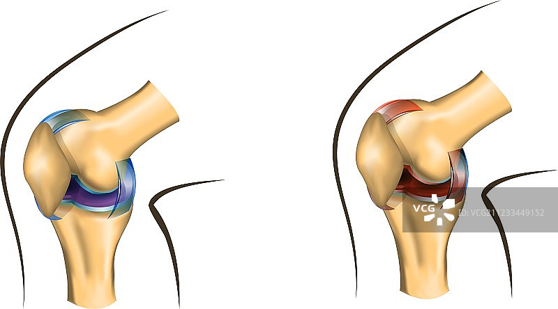 健康和受损的膝关节图片素材
