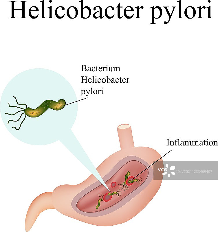 胃中幽门螺杆菌信息图图片素材