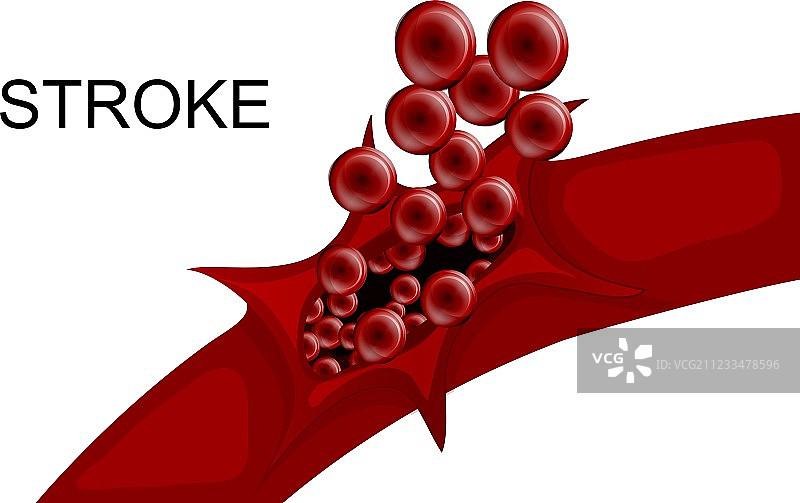 血管破裂引起的出血性中风图片素材