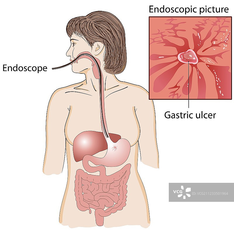 内窥镜检查图片素材